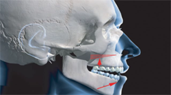 correcting-open-bite