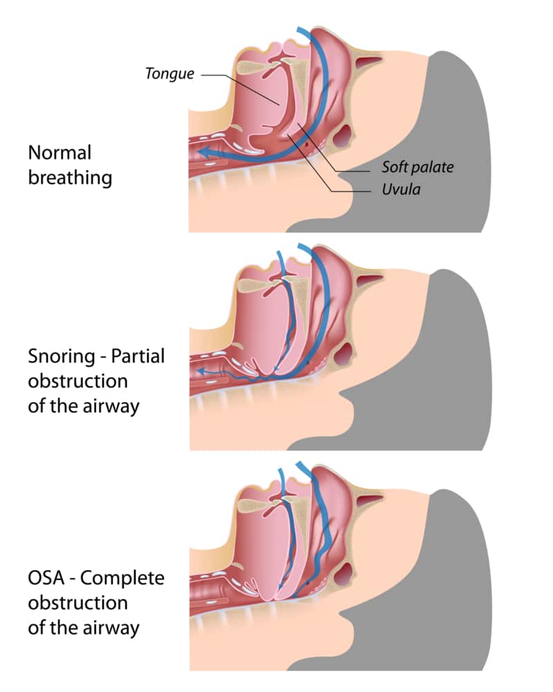 Infographic illustrating the difference in airway constriction between sleep apnea and a healthy airway