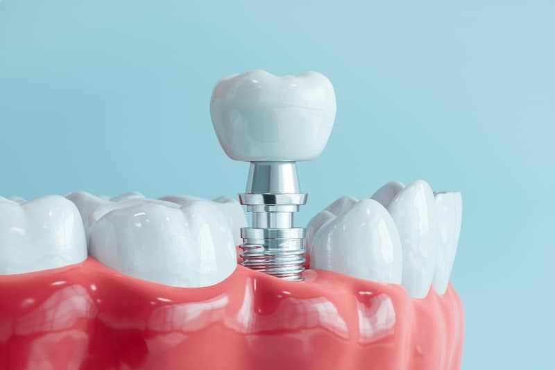 Close-up dental implant restoration procedure with titanium implant and crown in Austin, TX