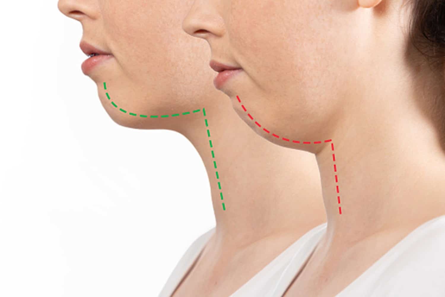 Corrective Jaw Surgery