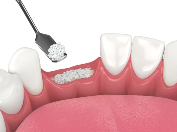 Bone Grafting for Dental Implants: Process, Cost & Recovery