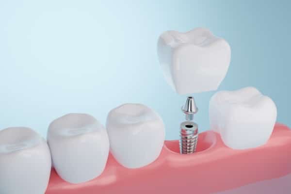 Dental Implant Timeline: How Long Does the Process Take?