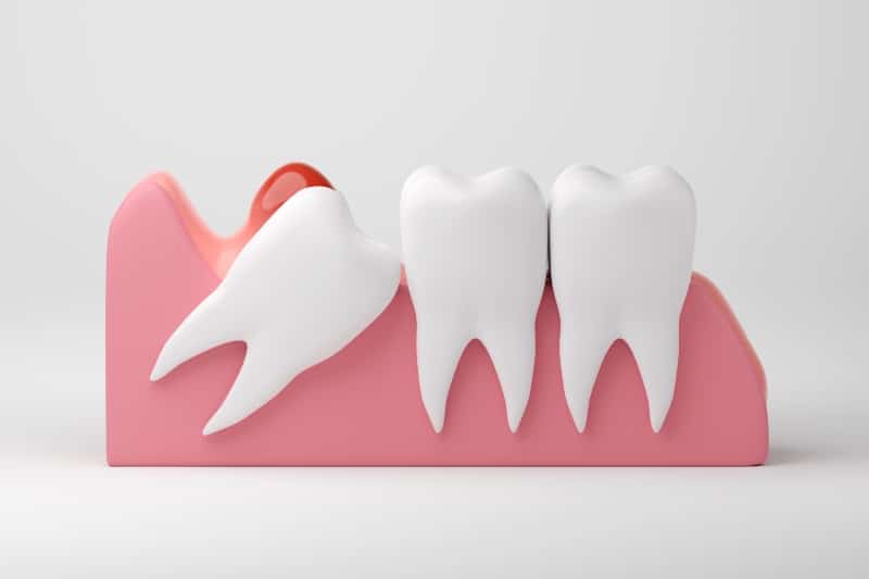 Wisdom tooth growing sideways beneath gums beside healthy molars illustration in Austin, TX