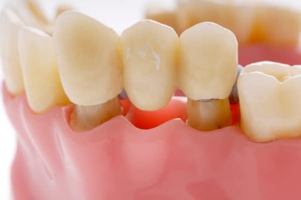 Dental Implants vs. Bridges: Which Is Right for You?