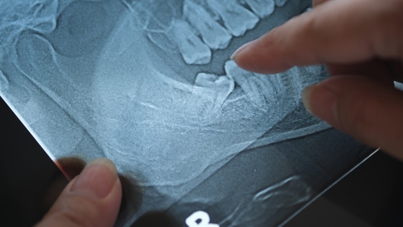 Panoramic X-ray of impacted wisdom teeth in Austin, TX