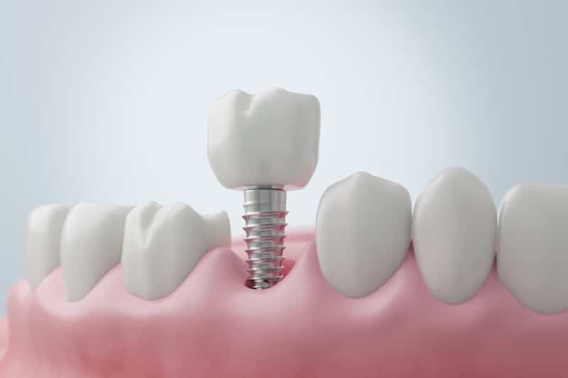 Single dental implant replacing a missing tooth with natural-looking restoration in Austin, TX