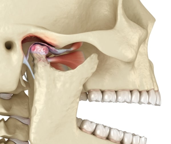 Understanding TMJ Pain: Causes, Treatment & When to See a Specialist