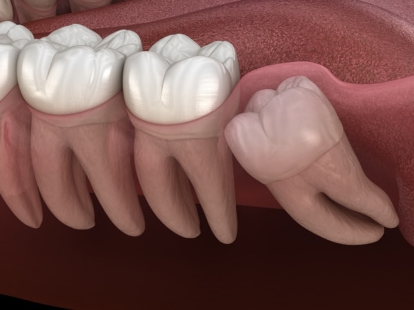 Do Wisdom Teeth Always Need to Be Removed?