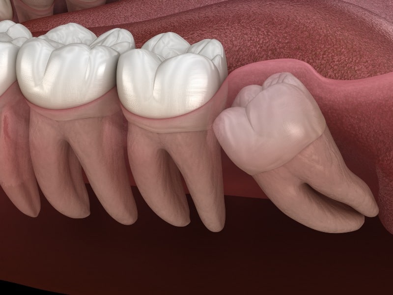 Wisdom tooth impaction at molar tooth 3D illustration in Austin, TX